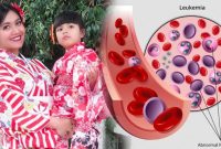 Ini Loh 5 Gejala Awal Leukimia atau Kanker Darah