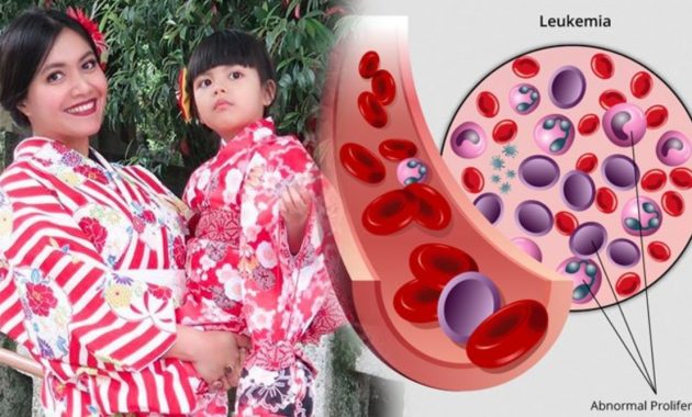 Ini Loh 5 Gejala Awal Leukimia atau Kanker Darah