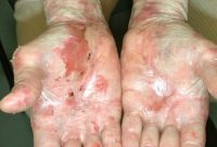 Perjuangan Gito, Bocah Pengidap Epidermolysis Bullosa (Penyakit Kulit Mengelupas)