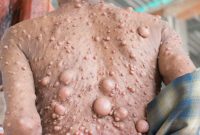 Bagaimana Seseorang bisa Mengidap Neurofibromatosis Tipe 2?