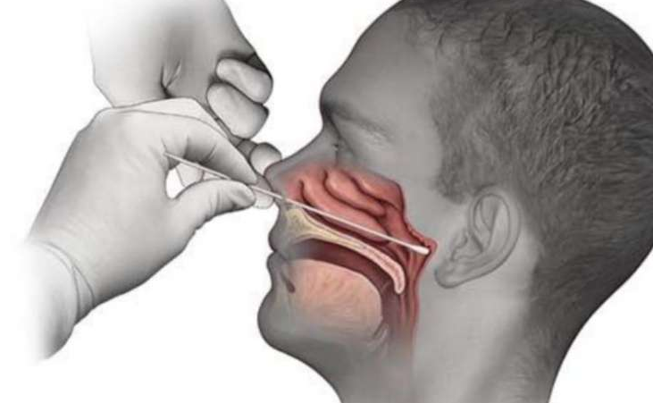 Tujuan dan Prosedur Penting Melakukan Swab Test Corona