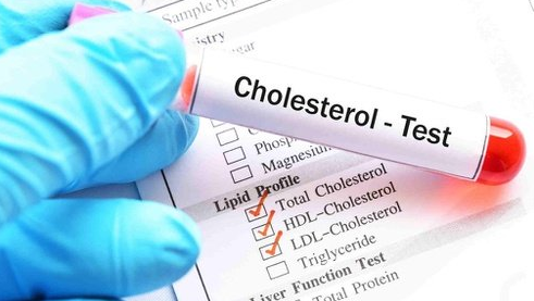 10 Ciri-ciri Kolesterol Tinggi yang Harus Diwaspadai