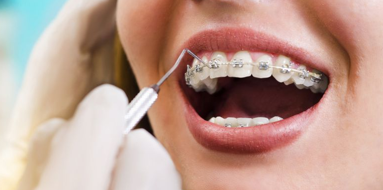 5 Kesalahan Memakai Kawat Gigi yang Sering Dilakukan