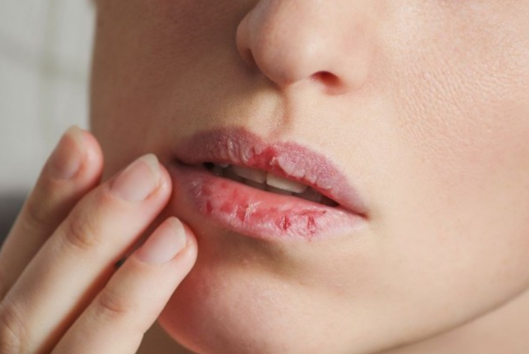 5 Penyakit Langka pada Bibir yang Harus Diwaspadai