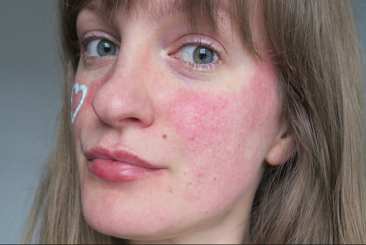 Mengenal Rosacea, Penyakit Kulit yang Dialami Maia Estianty, Apa Gejalanya?