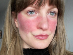 Mengenal Rosacea, Penyakit Kulit yang Dialami Maia Estianty, Apa Gejalanya?