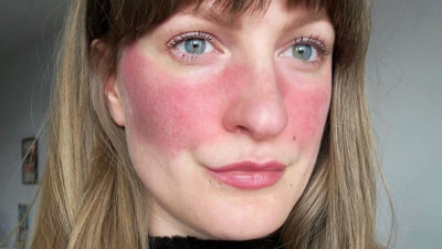 Mengenal Rosacea, Penyakit Kulit yang Dialami Maia Estianty, Apa Gejalanya?