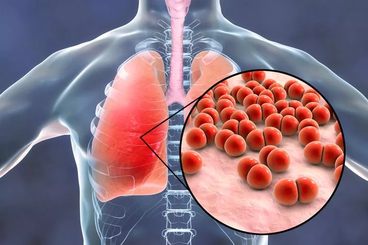 Mengenal Mycoplasma Pneumonia, Penyakit yang Baru Ditemukan di RI Bagaimana Gejalanya?